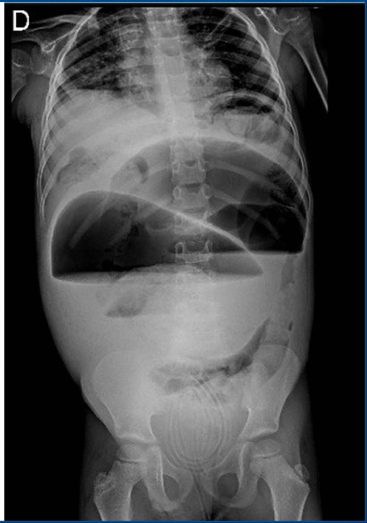 Sigmoid Volvulus As A Complication Of Imperforate Anus A Case Report sigmoid-volvulus-as-a-complication-of-imperforate-anus-a-case-report